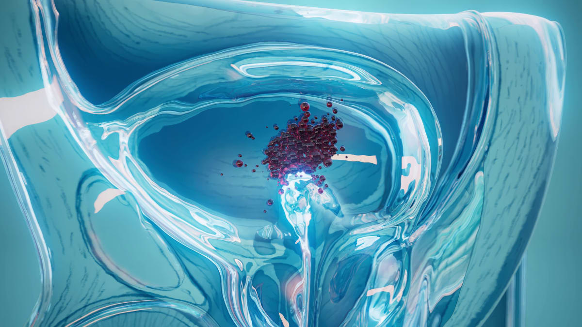 Blood Test May Predict Bladder Cancer Treatment Success