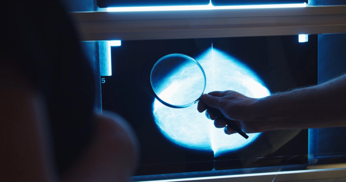Dutch Test Spares Breast Cancer Patients Chemo