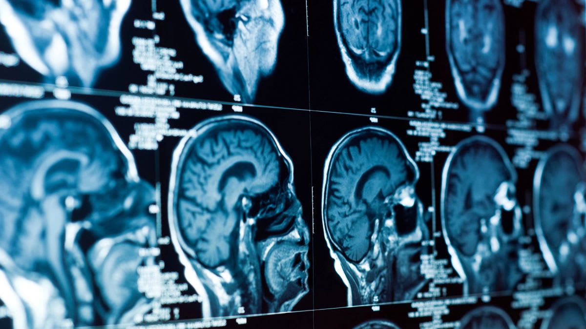 Amsterdam Finds Treatment for Fatal Child Brain Disease