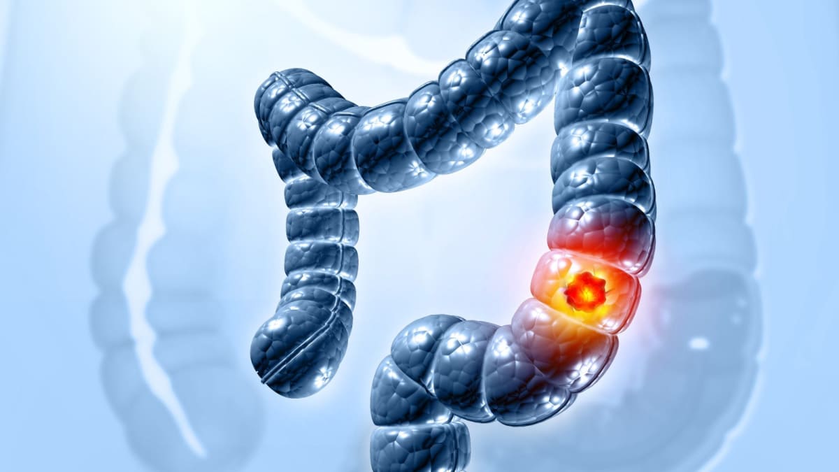 Doctor Launches Fast-Track Platform for Colon Cancer Trials - Image 2