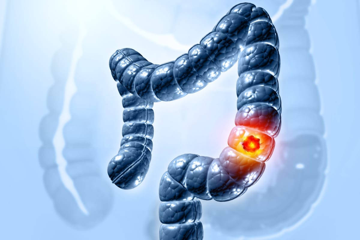 Doctor Launches Fast-Track Platform for Colon Cancer Trials