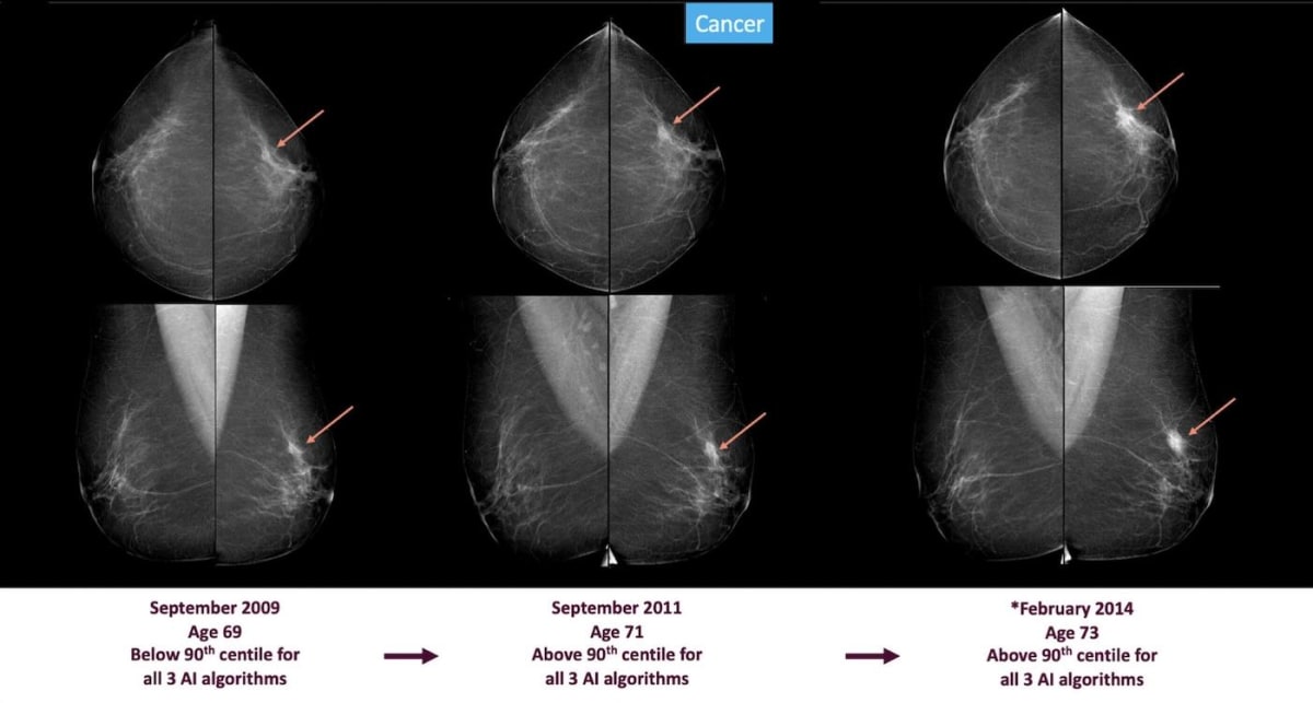 AI Detects Breast Cancer Signs Up to 6 Years Early