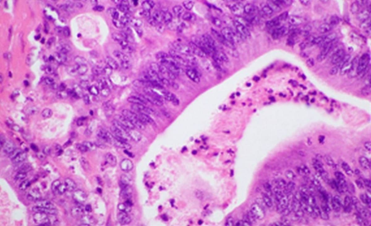 New Drug Prevents Pancreatic Cancer in 90% of Trial Patients