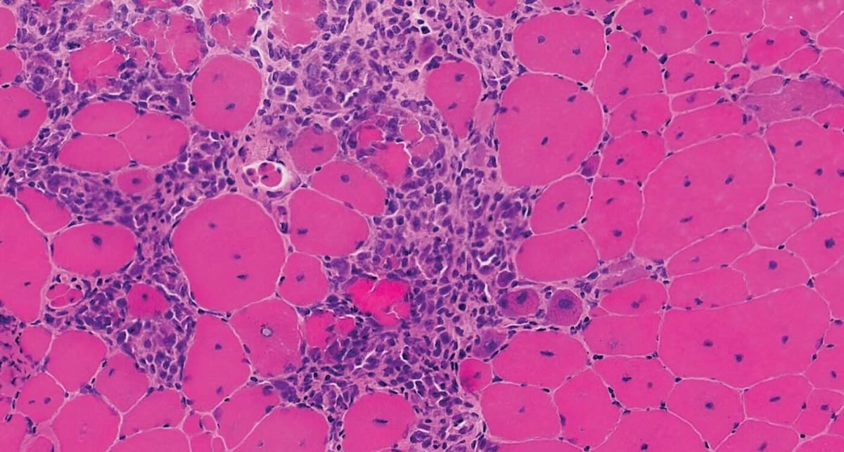 Microscopic view of muscle tissue showing dystrophin deficiency in Duchenne muscular dystrophy research