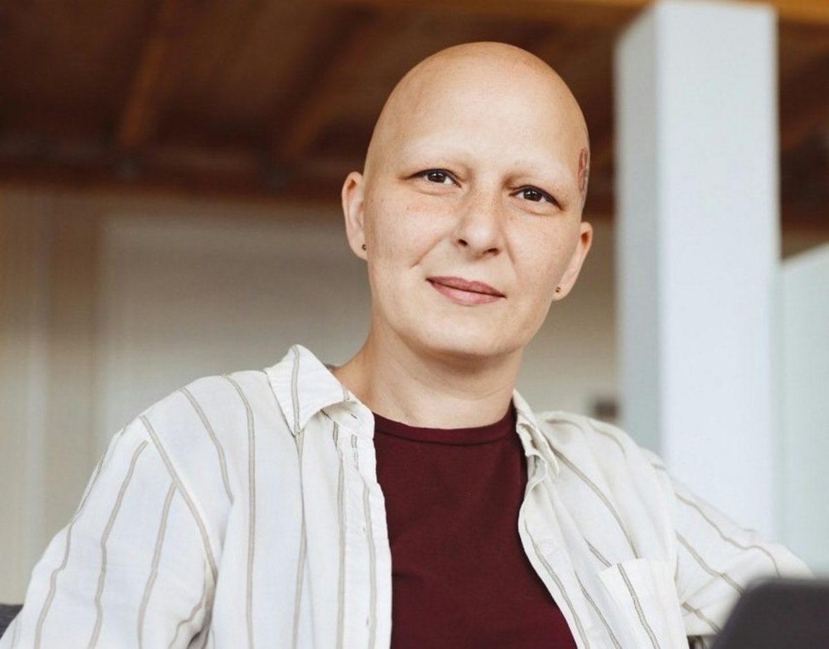 Arthritis Drug Restores Hair in 1,400 Alopecia Patients