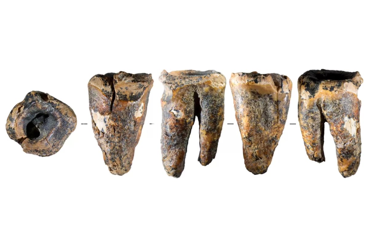 Ancient Neanderthal molar tooth from Siberia showing evidence of deliberate dental surgery from 59,000 years ago