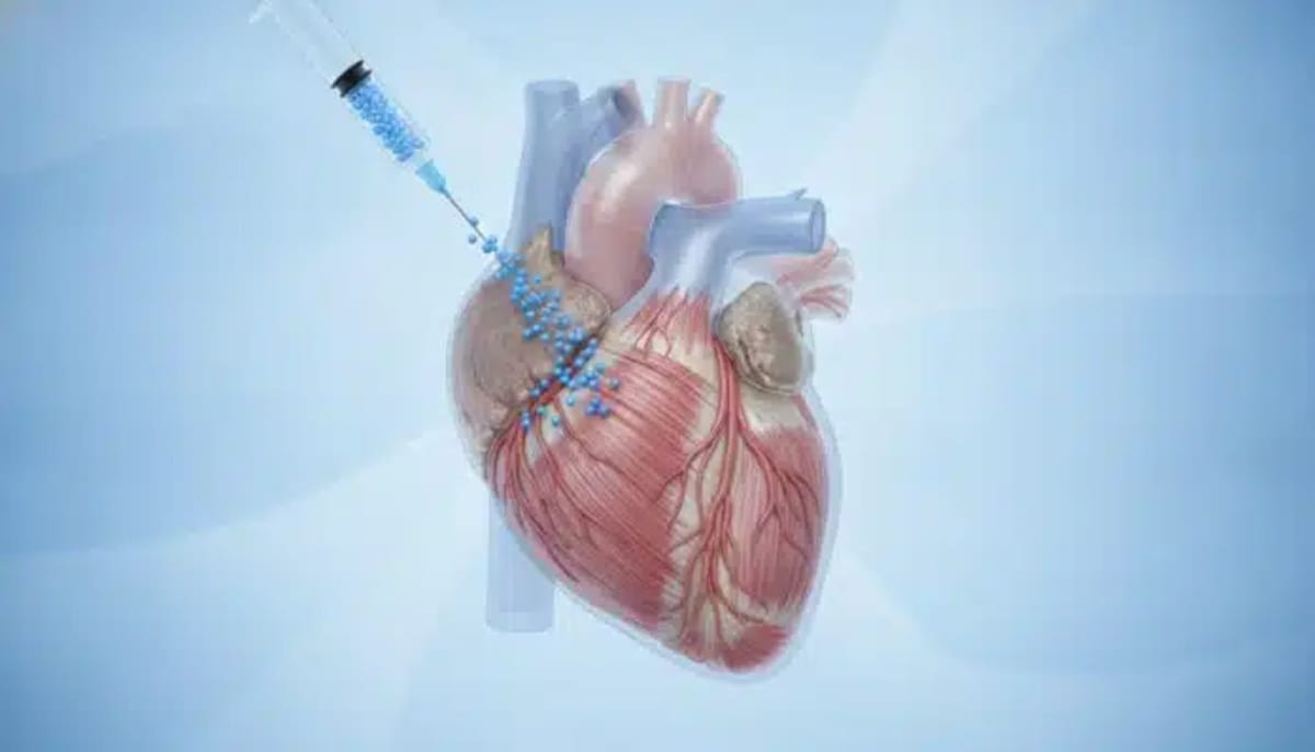 Stem Cells Restore Heart Function in 90% of Patients - Image 2