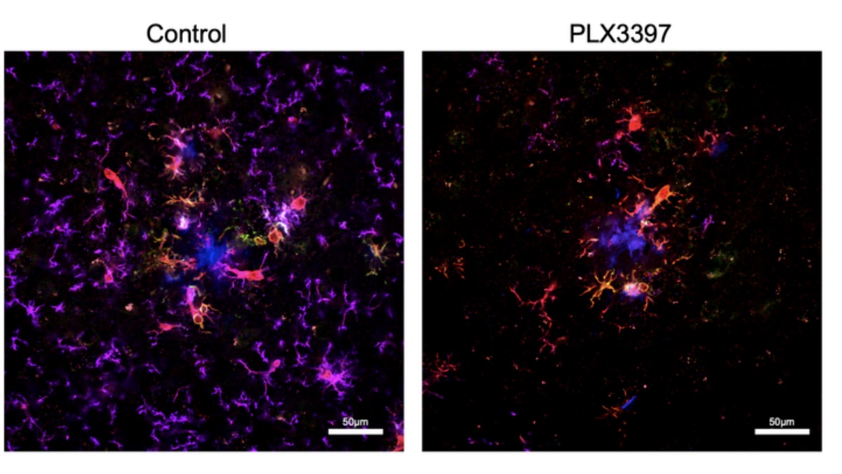 UK Scientists Restore 2 Hours of Sleep in Alzheimer's Study