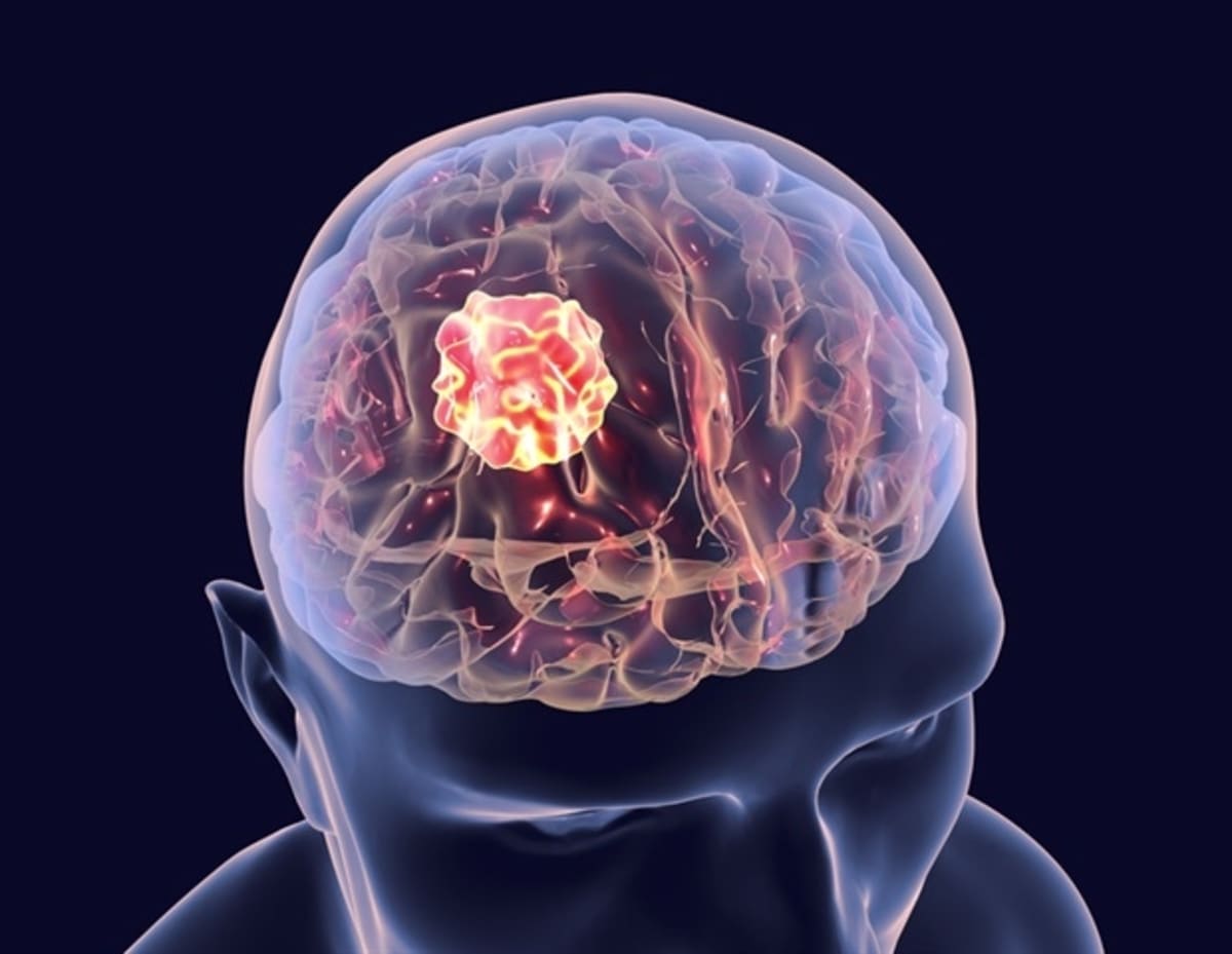 New Brain Cancer Treatment Doubles Survival in Mice