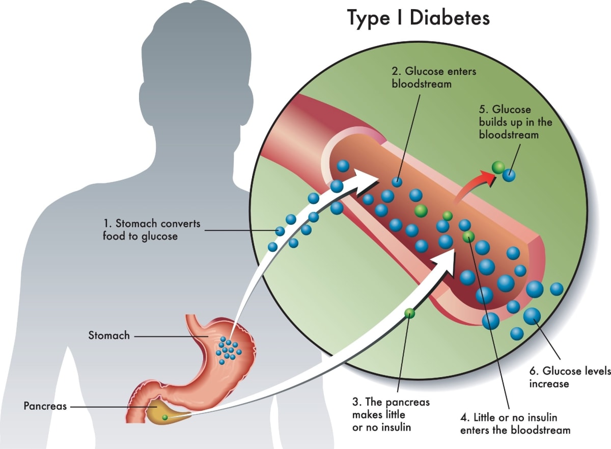 Medical researcher examining insulin-producing beta cells under microscope in diabetes laboratory
