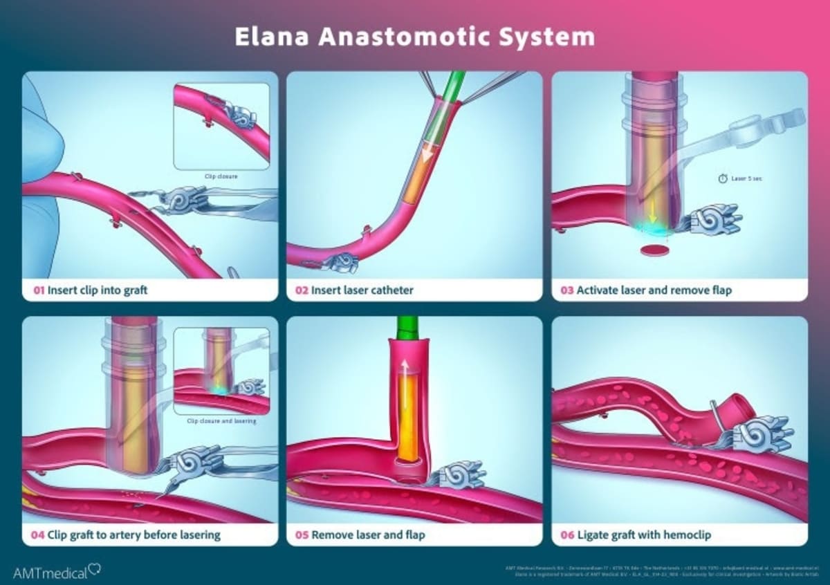 New Heart Bypass Tech Ends 60 Years of Hand-Sewn Surgery