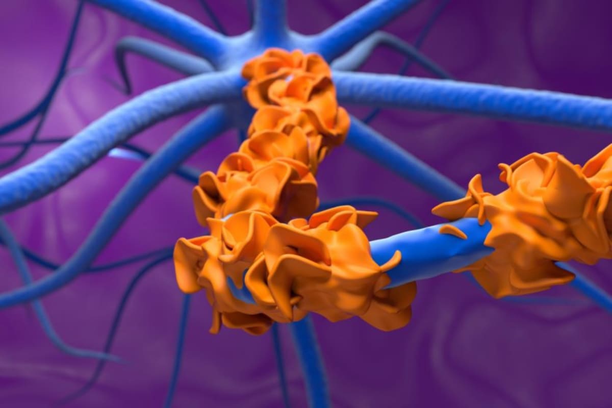 First Drug for Guillain-Barré Shows Success in Trials - Image 2