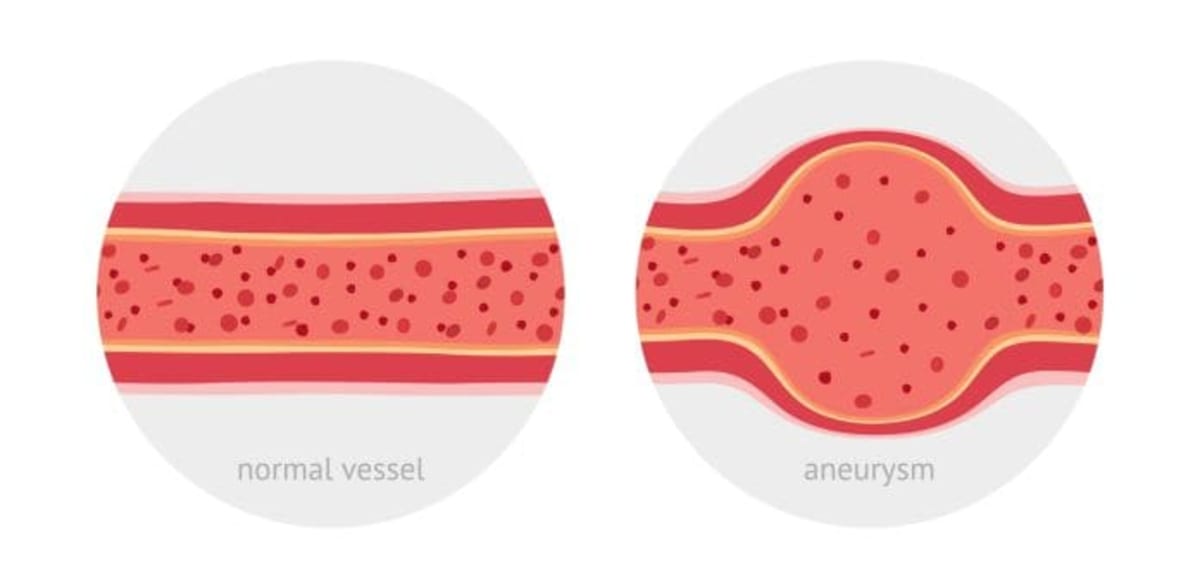 UK Approves New Treatment for Rare Swelling Disorder - Image 2