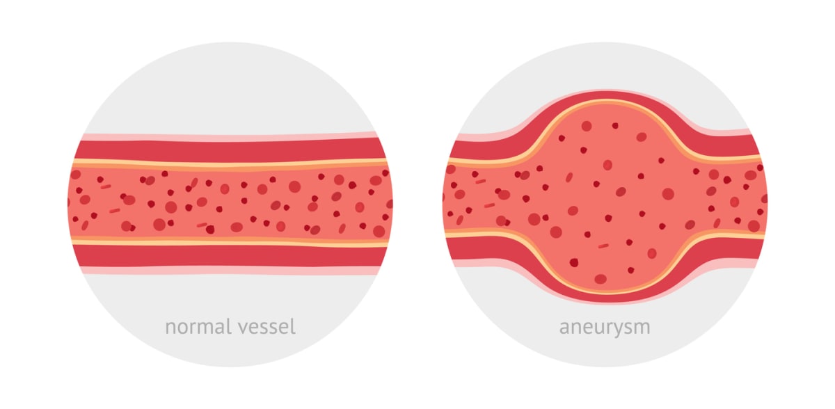 UK Approves New Treatment for Rare Swelling Disorder