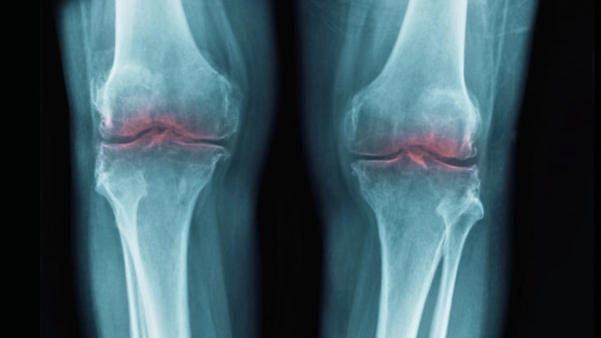 Scientists Reverse Arthritis in Mice, Human Trials Next - Image 2