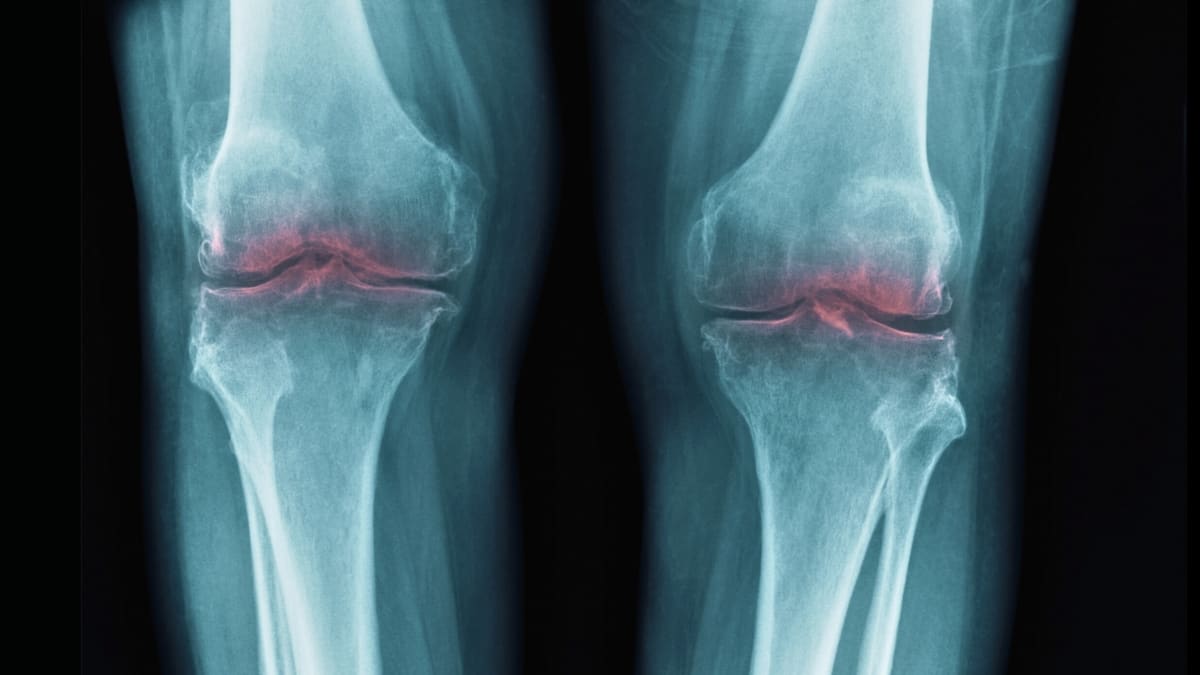 Scientists Reverse Arthritis in Mice, Human Trials Next