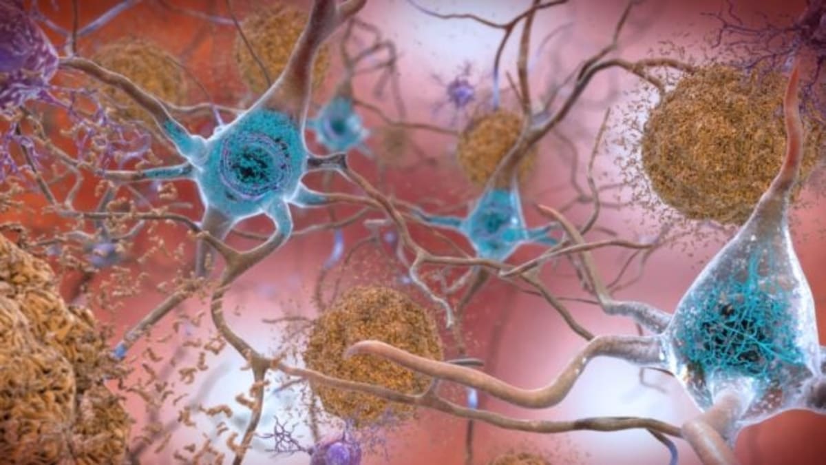 New Alzheimer's Drug Reverses Memory Loss in Mice - Image 3