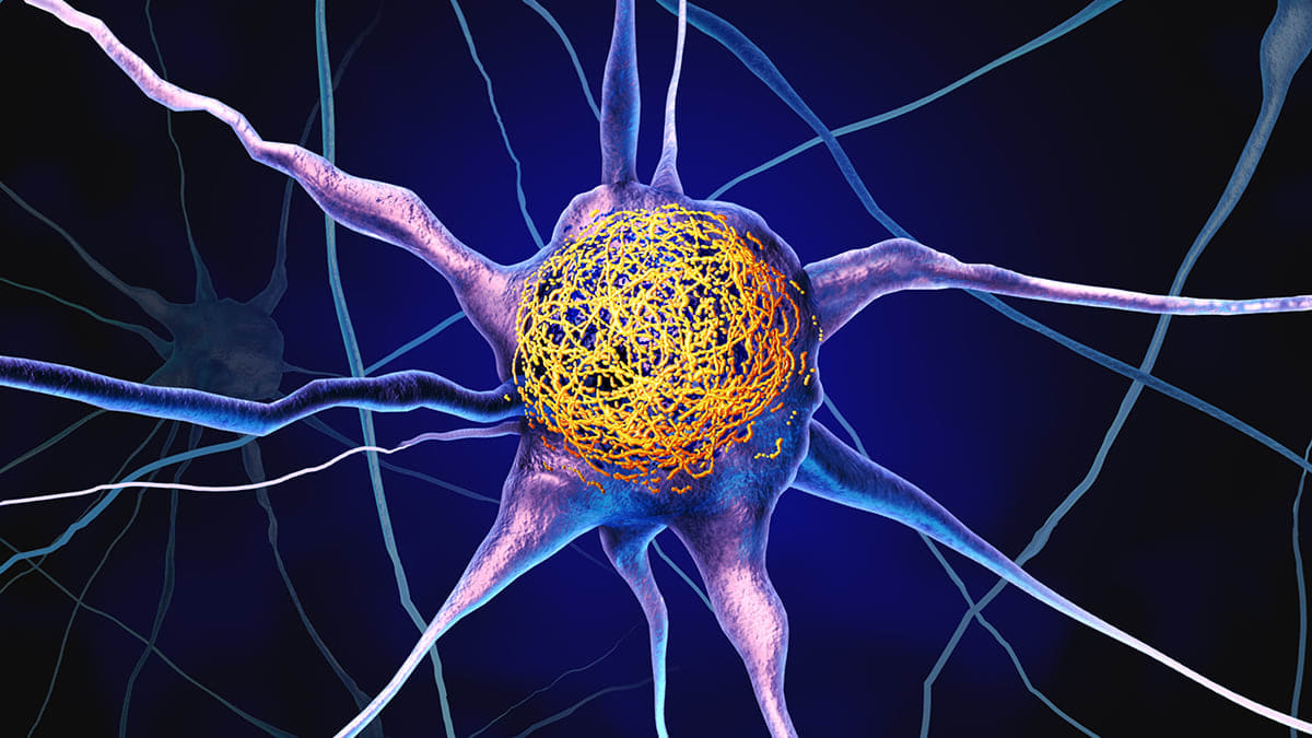 Vitamin D Linked to Lower Alzheimer's Risk in New Study