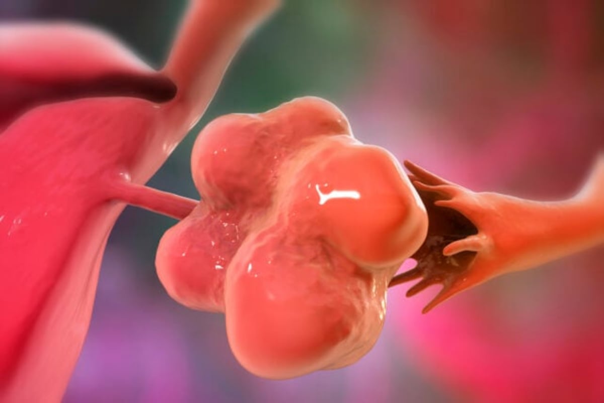 PCOS Renamed After 90 Years of Misleading Women Worldwide - Image 3