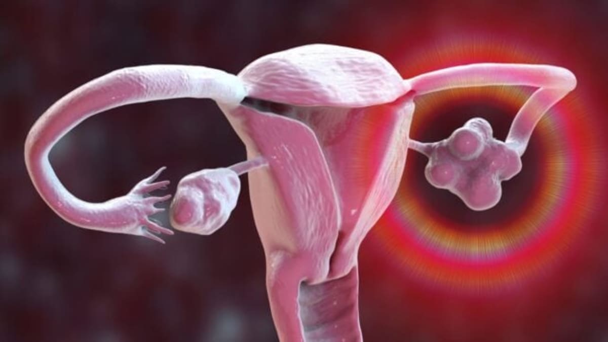 PCOS Renamed After 90 Years of Misleading Women Worldwide - Image 2