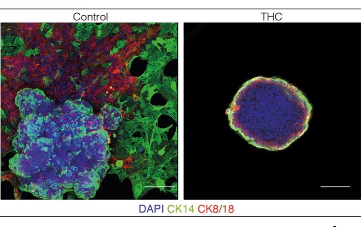 Cannabis Compound Stops Breast Cancer Cells from Spreading - Image 4
