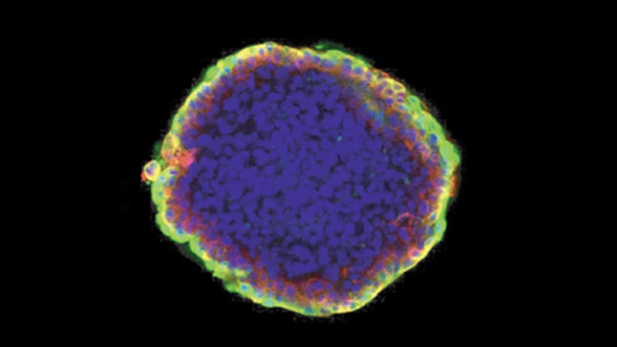Cannabis Compound Stops Breast Cancer Cells from Spreading