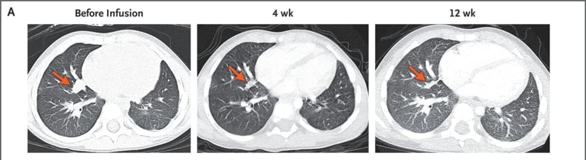 3-Year-Old's Liver Cancer Vanishes After New Treatment - Image 3