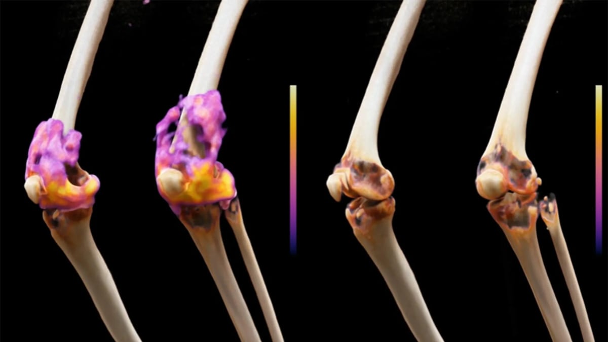 Cancer Therapy Puts Rheumatoid Arthritis Into Remission
