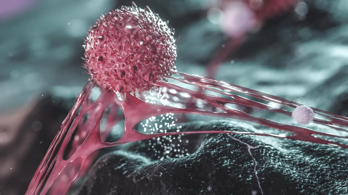 Microscopic view of breast cancer cells surrounded by protective immune cells and tissue