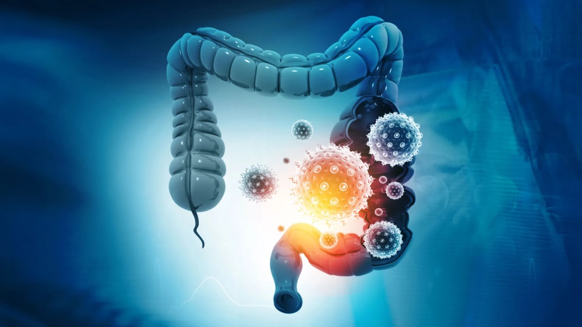 Colon Cancer's Microbial Fingerprint Could Transform Care