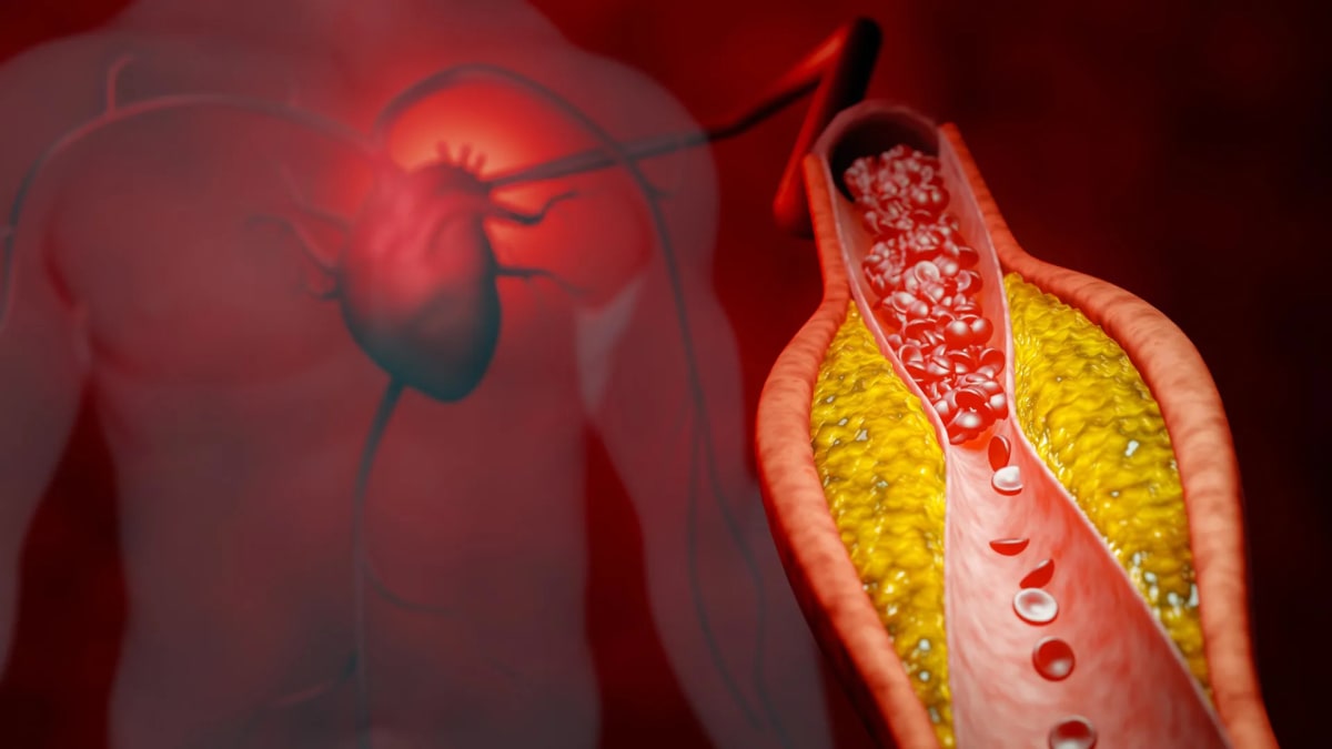 DNA Treatment Cuts Cholesterol 47% With Single Shot