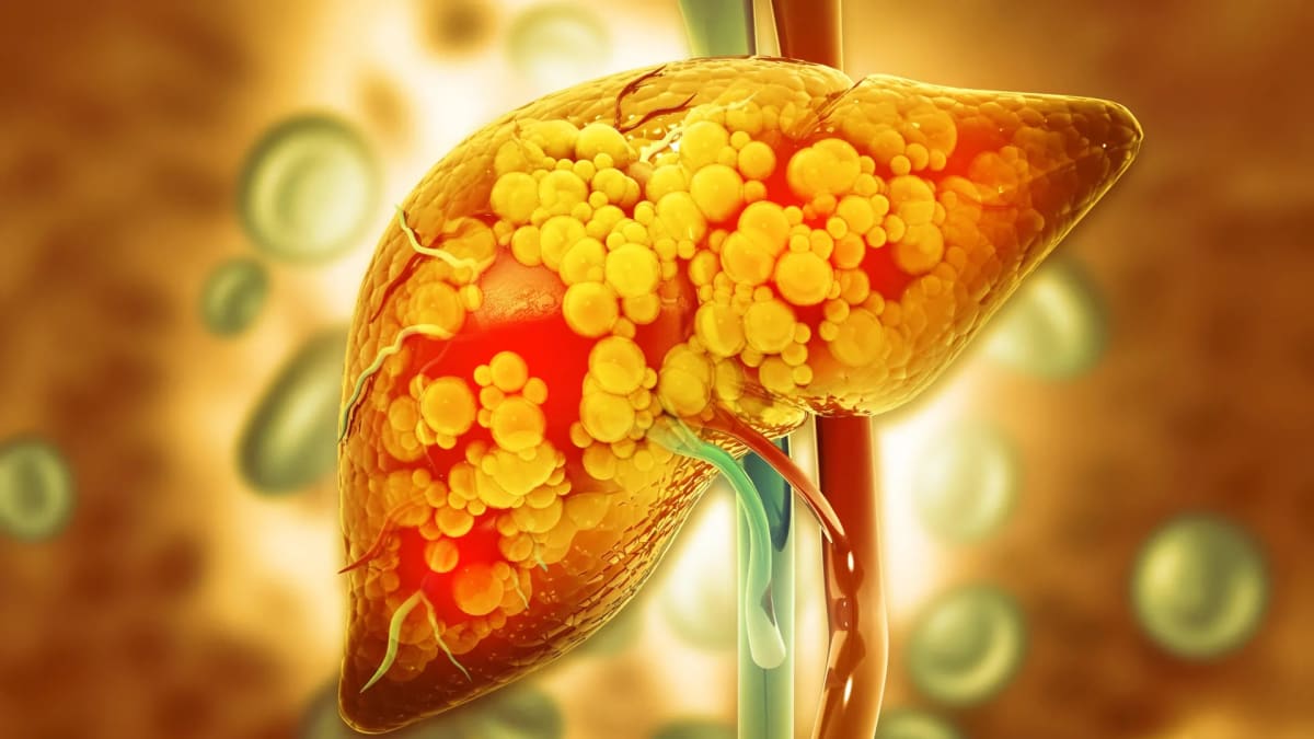 Keto Diet Slashes Liver Fat 67% in Obesity Trial