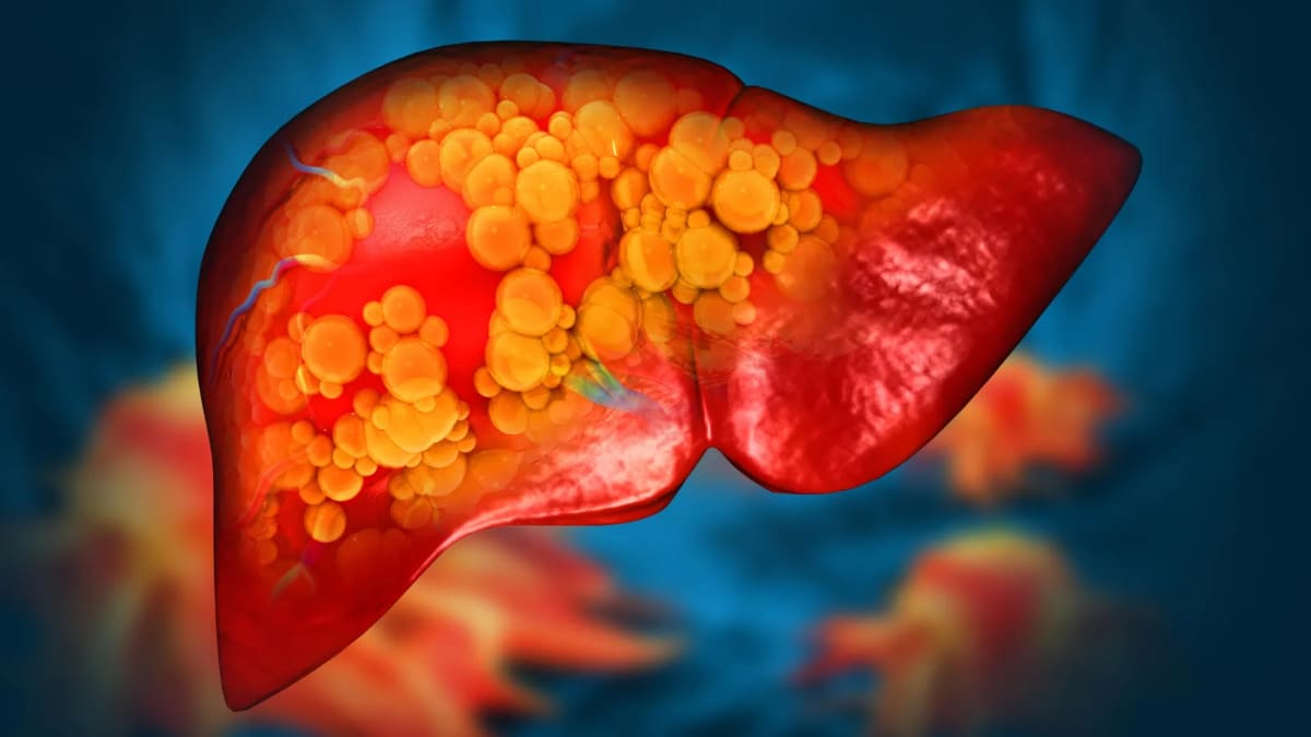 Mayo Clinic Finds Gene That Causes Fatty Liver Disease