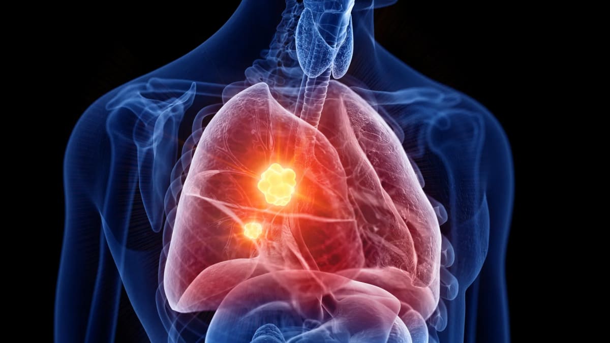 New Cancer Drug Controlled Disease in 67% of Patients