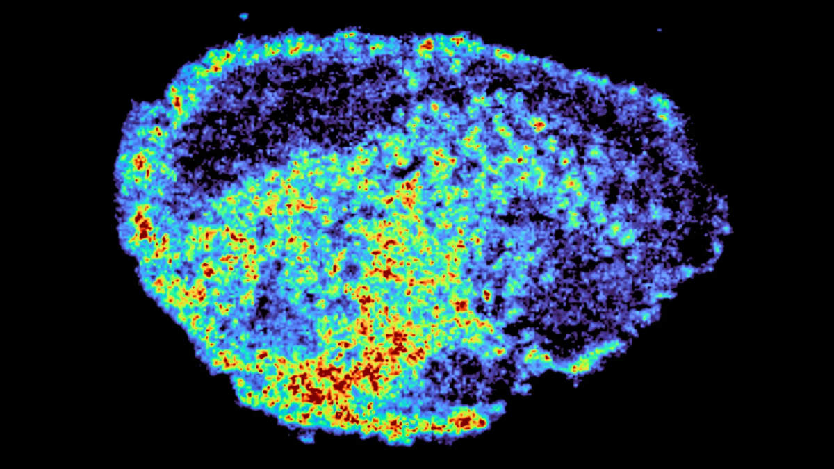 Mass spectrometry image showing PARP inhibitor drug concentration hotspots in red and orange within human ovarian tumor tissue