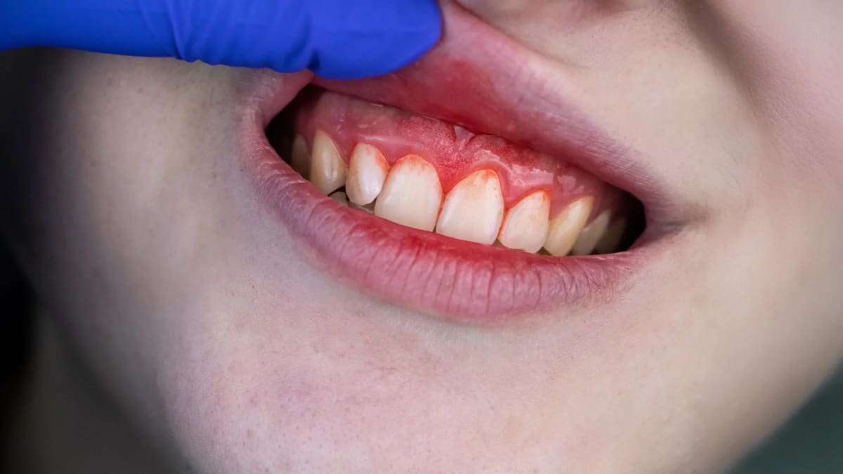 Person holding omega-3 fish oil supplements and low-dose aspirin tablets for gum disease treatment