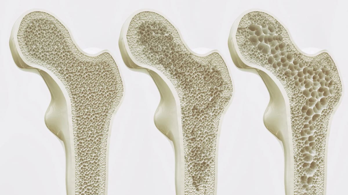Ozempic Users See 15% Fewer Bone Fractures in Study