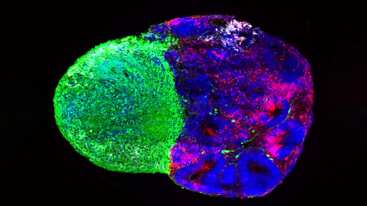 Green and red brain organoids merged together showing white radial glia stem cells during development