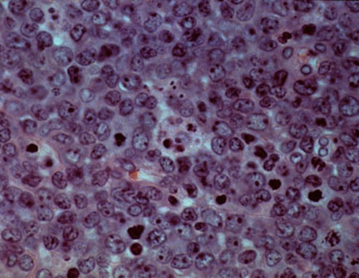 New Cancer Treatment Triples Cell Elimination in Lymphoma - Image 2