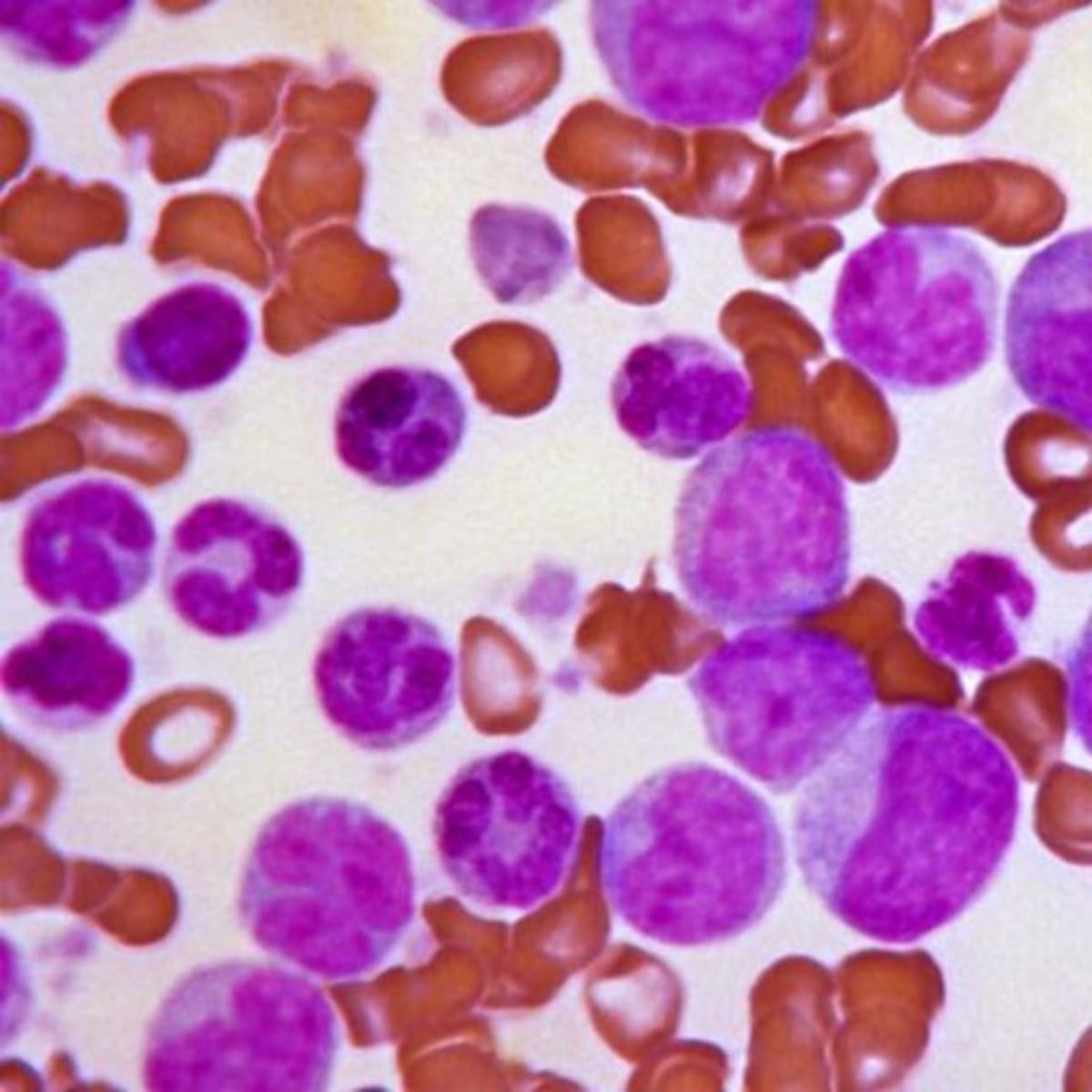 Leukemia Drug Shows 48% Response Rate in Early Trial - Image 2