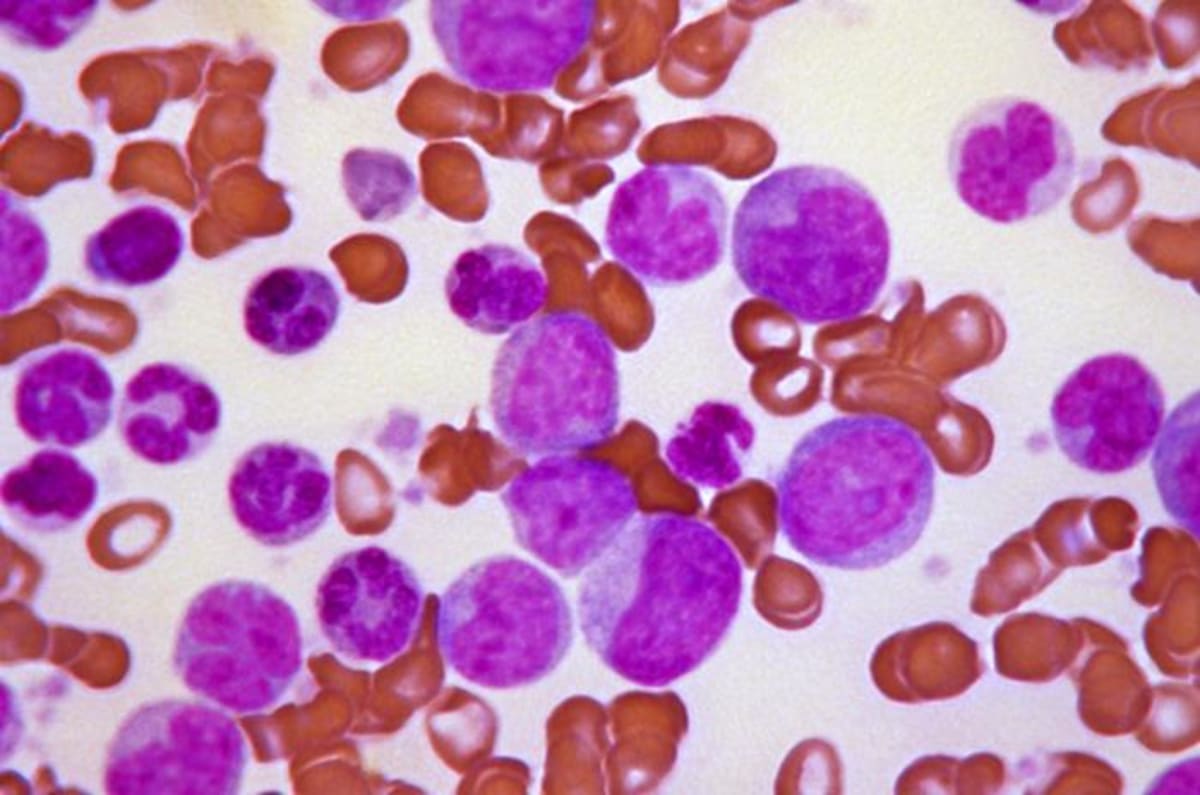 Leukemia Drug Shows 48% Response Rate in Early Trial