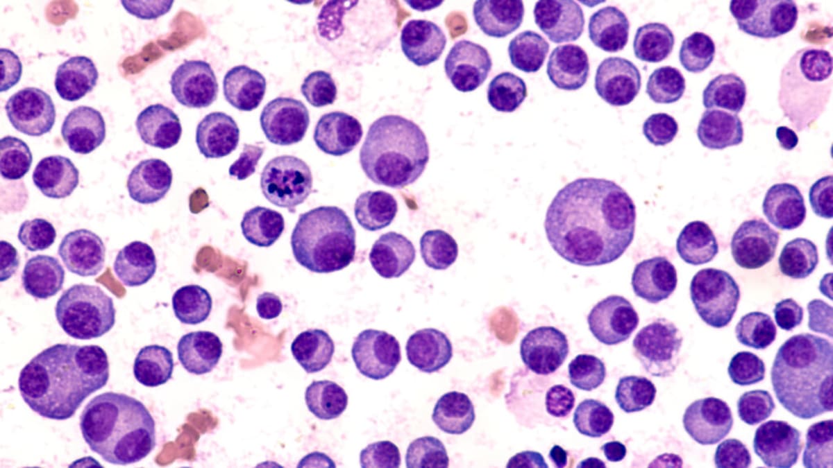 CAR-T Therapy Erases Cancer Risk in 20 Myeloma Patients