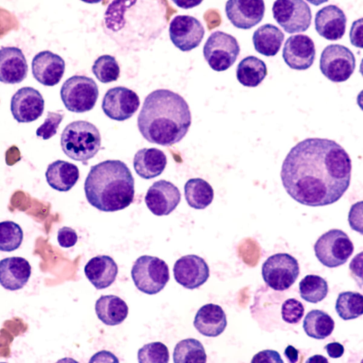 CAR-T Therapy Erases Cancer Risk in 20 Myeloma Patients - Image 2