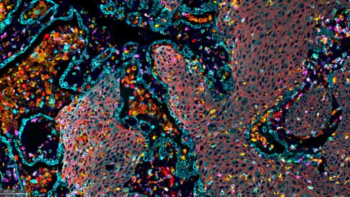 New Pancreatic Cancer Drug Shows Unprecedented Results