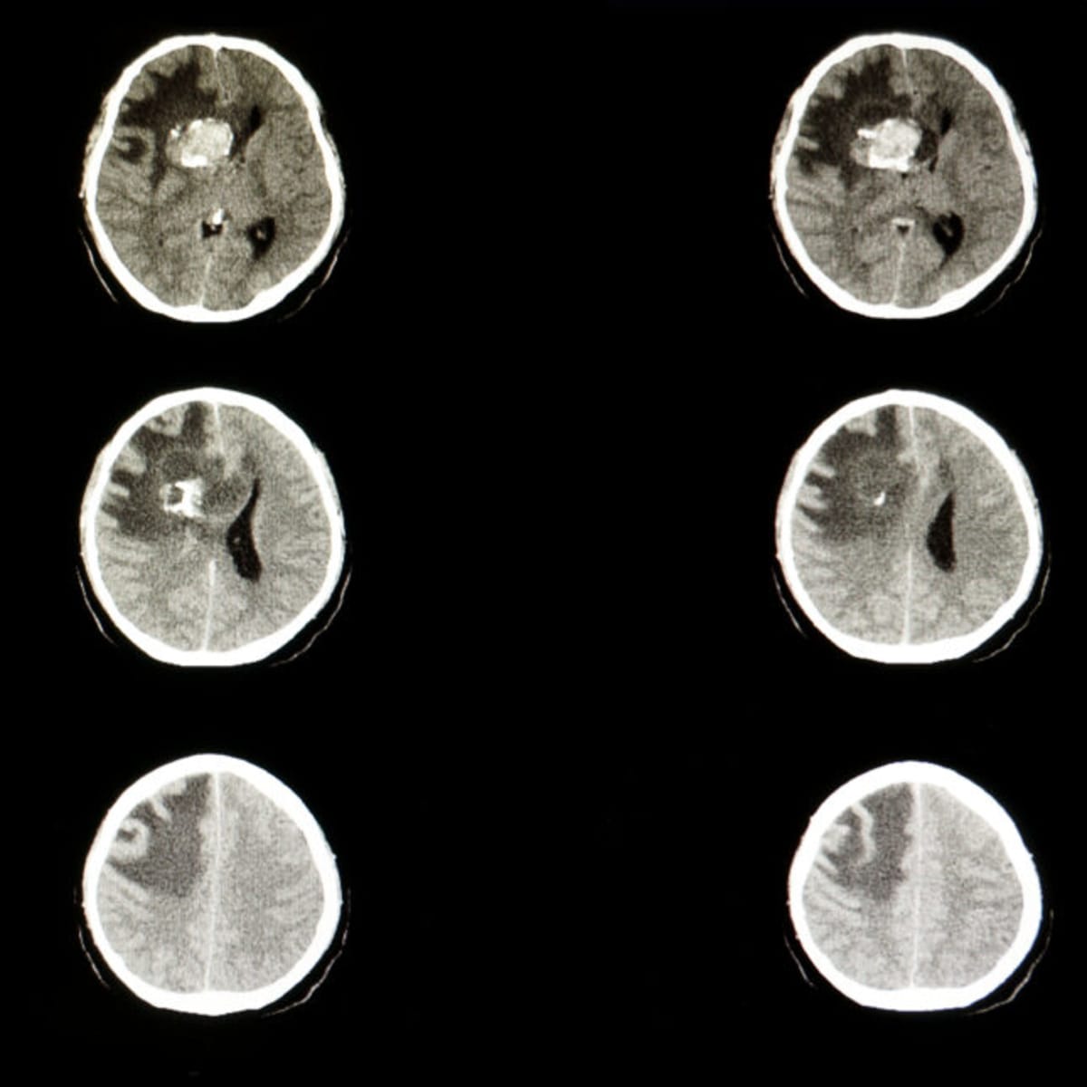 French Pharma Buys Brain Cancer Drug Maker for $2.5B - Image 2