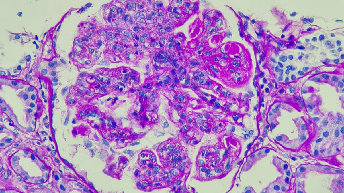 Lupus Patient Now Works in Clinic That Saved Her Life