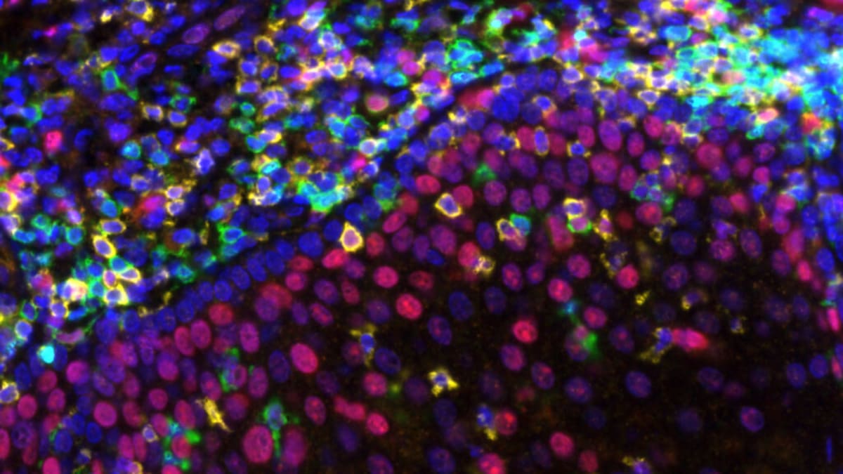 Lower-Dose Cancer Drug Extends Lives in India for $230/Month