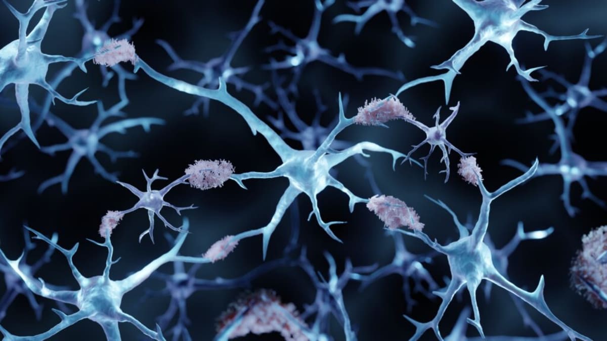 New Alzheimer's Drug Shows Safer Brain Scan Results