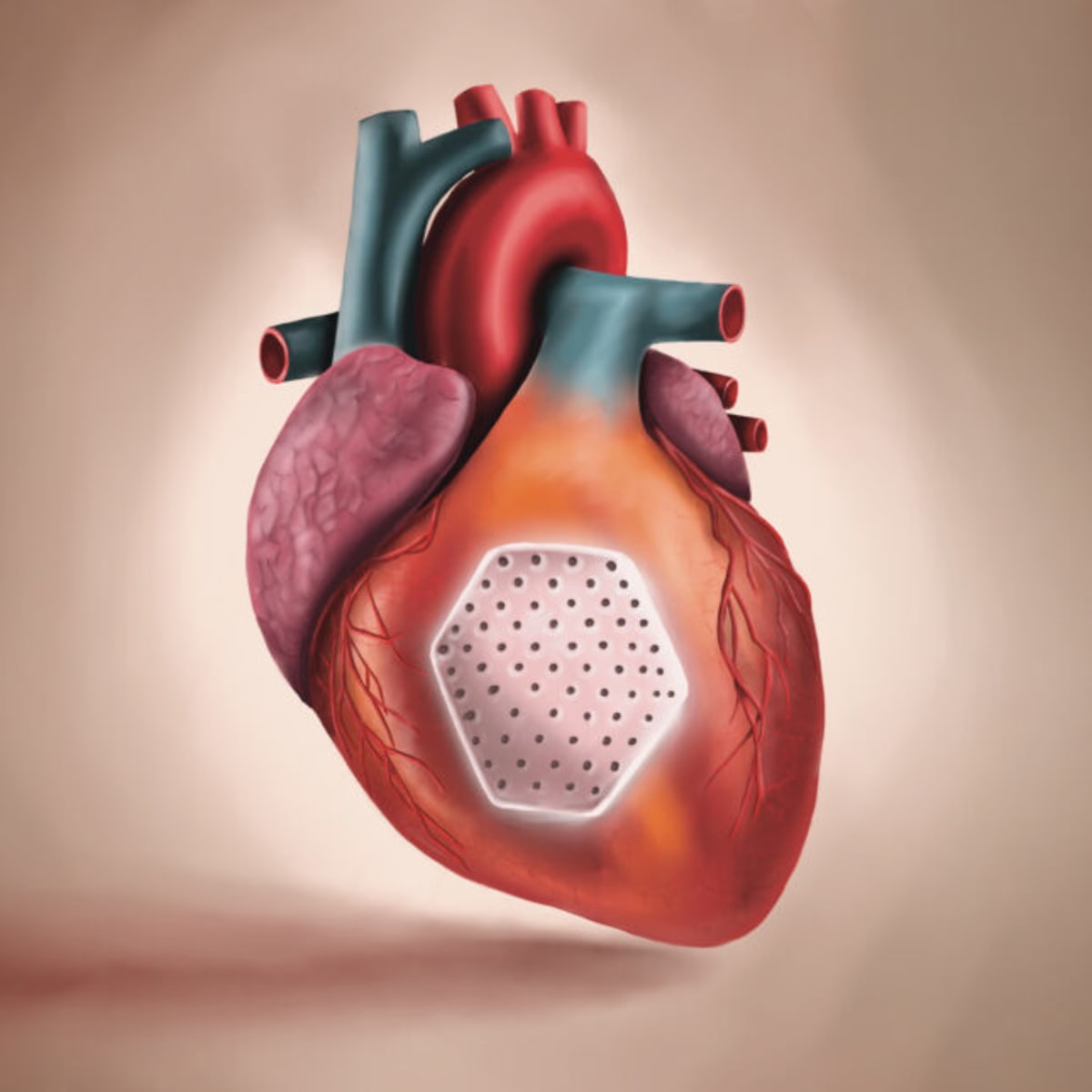 Stem Cell Heart Patches Help Failing Hearts Pump Again - Image 2
