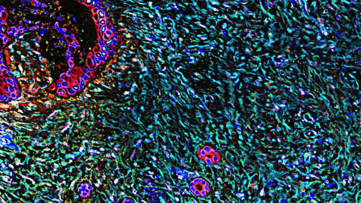 Pancreatic Cancer Drug Doubles Survival in Major Trial